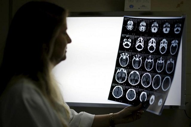 child neurologist vanessa van der linden observes the x ray of a baby 039 s skull with microcephaly at the hospital barao de lucena in recife brazil photo reuters