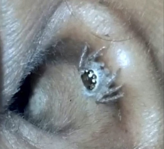 doctors find live spider inside indian woman s ear doctors find live spider inside indian woman s ear