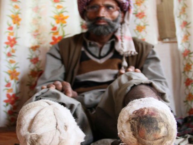 khatana says indian troops cut off his legs sliced flesh from his waist with a blade and then forced him to eat bits of it photo courtesy worldwithouttorture org