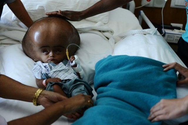 roona begum 039 s condition caused her head to swell to a circumference of 94 centimetres 37 inches photo afp roona begum 039 s condition caused her head to swell to a circumference of 94 centimetres 37 inches photo afp