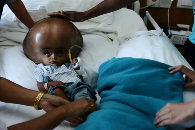 roona begum 039 s condition caused her head to swell to a circumference of 94 centimetres 37 inches photo afp roona begum 039 s condition caused her head to swell to a circumference of 94 centimetres 37 inches photo afp