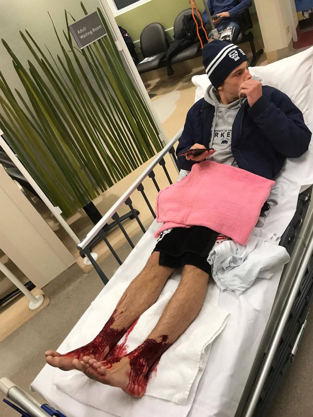 this handout picture taken and released by jarrod kanizay father of australian teenager sam kanizay on august 7 2017 shows sam kanizay with his injured feet waiting for medical aide at hospital in melbourne photo afp