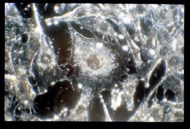 cancer cells are seen in this undated handout image photo reuters cancer cells are seen in this undated handout image photo reuters