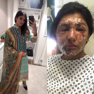 muslim model attacked with acid in london shows her recovery through pictures