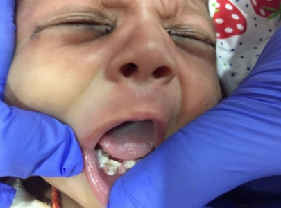 indian doctors remove seven teeth from month old infant s mouth indian doctors remove seven teeth from month old infant s mouth