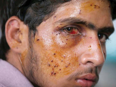 amnesty calls for ban on pellet shotguns in held kashmir