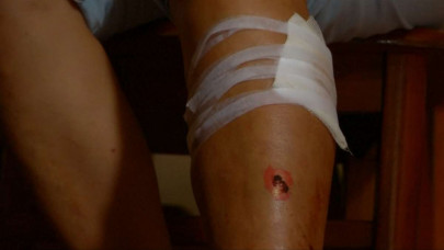 alarm over flesh eating ulcer cases in australia alarm over flesh eating ulcer cases in australia