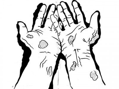 special report a leper s tale