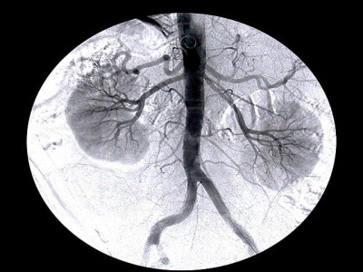 pulverising kidney stones in rawalpindi through non invasive procedure pulverising kidney stones in rawalpindi through non invasive procedure