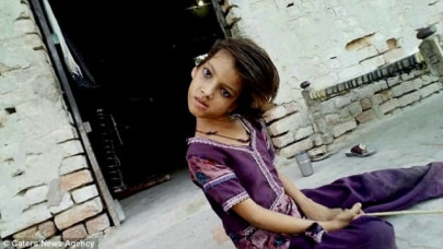 rare muscular disorder forces girl to live as a pariah