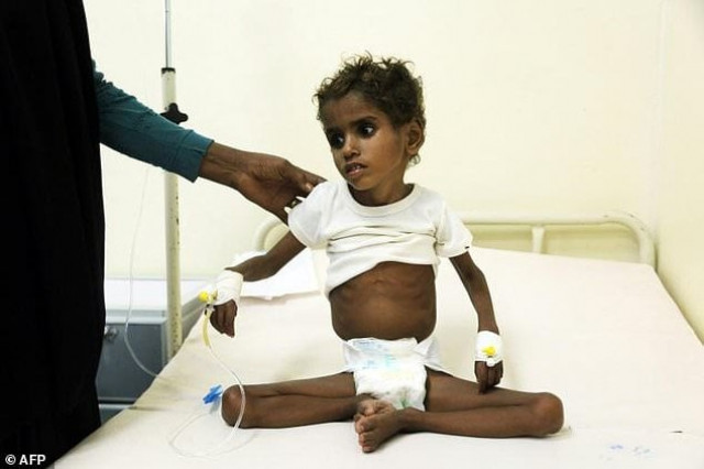 a malnourished child receives treatment at a hospital in the yemeni port city of hodeidah on november 5 2017 photo afp a malnourished child receives treatment at a hospital in the yemeni port city of hodeidah on november 5 2017 photo afp