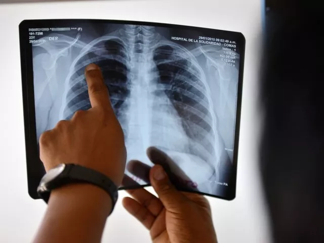 notes that funds allocated for tuberculosis control given to private hospitals ngos and hospitals photo file notes that funds allocated for tuberculosis control given to private hospitals ngos and hospitals photo file
