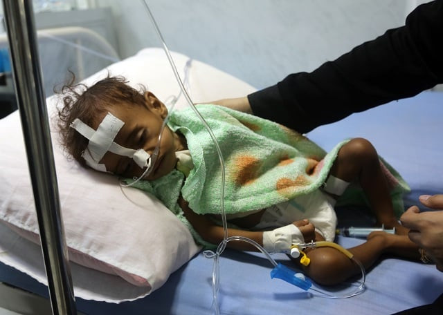 a malnourished yemeni child receives treatment at a hospital in the yemeni port city of hodeidah on november 21 2017 photo afp a malnourished yemeni child receives treatment at a hospital in the yemeni port city of hodeidah on november 21 2017 photo afp