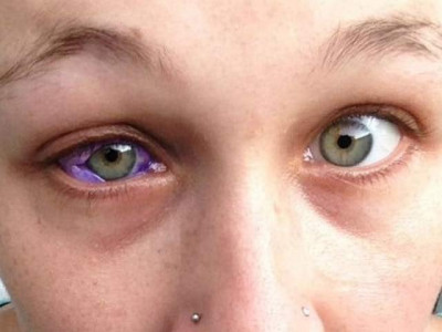 model s eyeball tattoo leaves her partially blind makes her cry purple tears model s eyeball tattoo leaves her partially blind makes her cry purple tears