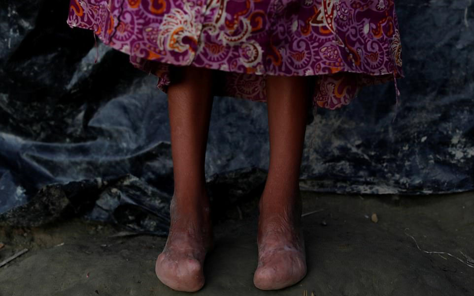 a four year old suffered burn injuries from being forced to sit on a hot frying pan photo reuters