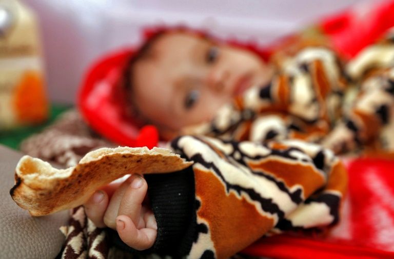 a malnourished yemeni child receives treatment at a hospital in the capital sanaa photo afp