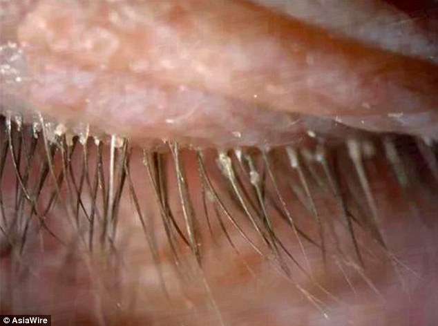 woman s eyelashes infested with 100 parasites after not washing pillowcase for 5 years