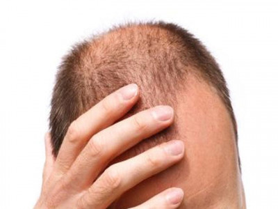 27 year old indian man commits suicide due to persistent hair fall 27 year old indian man commits suicide due to persistent hair fall