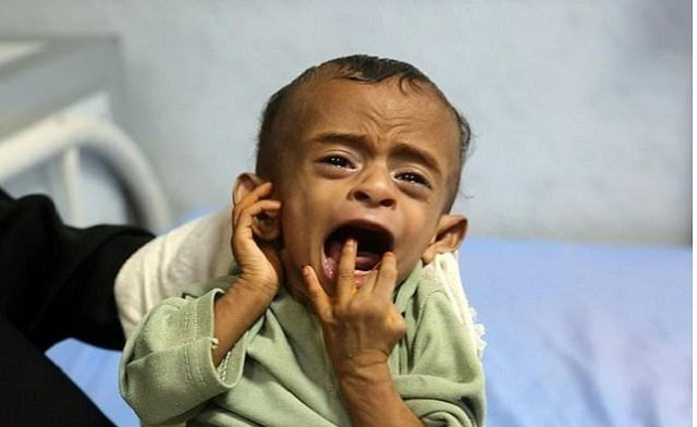 a yemeni child receives treatment at a hospital in the rebel held port city of hodeida on january 16 2018 one of around 400 000 children the un says are severely malnourished after nearly three years of conflict photo afp a yemeni child receives treatment at a hospital in the rebel held port city of hodeida on january 16 2018 one of around 400 000 children the un says are severely malnourished after nearly three years of conflict photo afp