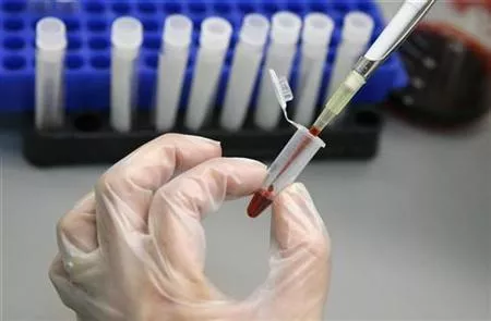 a laboratory technician examines blood samples for hiv aids photo reuters a laboratory technician examines blood samples for hiv aids photo reuters