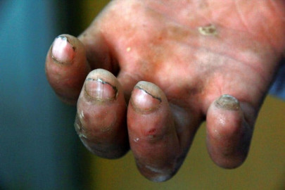 contagious experts stress need for eradicating leprosy in pakistan