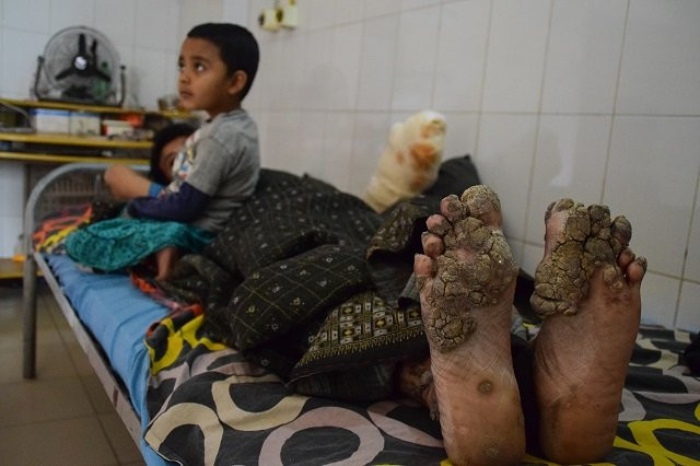 this picture taken on january 31 2018 shows quot tree man quot abul bajandar with his daughter at dhaka medical college hospital in dhaka a year ago abul bajandar a bangladeshi rickshaw puller dubbed quot tree man quot for the bark like growths that once covered his body appeared to have made a full recovery from the rare condition that has afflicted him for a decade twelve months after doctors declared him all but cured following 24 surgeries bajandar 039 s hands are once again covered in the growths that characterise his rare condition photo afp this picture taken on january 31 2018 shows quot tree man quot abul bajandar with his daughter at dhaka medical college hospital in dhaka a year ago abul bajandar a bangladeshi rickshaw puller dubbed quot tree man quot for the bark like growths that once covered his body appeared to have made a full recovery from the rare condition that has afflicted him for a decade twelve months after doctors declared him all but cured following 24 surgeries bajandar 039 s hands are once again covered in the growths that characterise his rare condition photo afp