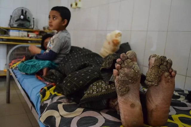 this picture taken on january 31 2018 shows quot tree man quot abul bajandar with his daughter at dhaka medical college hospital in dhaka a year ago abul bajandar a bangladeshi rickshaw puller dubbed quot tree man quot for the bark like growths that once covered his body appeared to have made a full recovery from the rare condition that has afflicted him for a decade twelve months after doctors declared him all but cured following 24 surgeries bajandar 039 s hands are once again covered in the growths that characterise his rare condition photo afp this picture taken on january 31 2018 shows quot tree man quot abul bajandar with his daughter at dhaka medical college hospital in dhaka a year ago abul bajandar a bangladeshi rickshaw puller dubbed quot tree man quot for the bark like growths that once covered his body appeared to have made a full recovery from the rare condition that has afflicted him for a decade twelve months after doctors declared him all but cured following 24 surgeries bajandar 039 s hands are once again covered in the growths that characterise his rare condition photo afp