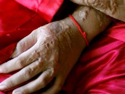 masked man throws acid on four girls in sialkot masked man throws acid on four girls in sialkot