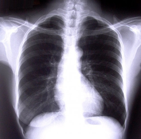 current or former heavy smokers screened with low dose ct scans experienced a 20 percent reduction in lung cancer deaths current or former heavy smokers screened with low dose ct scans experienced a 20 percent reduction in lung cancer deaths