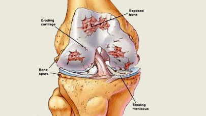 drug compound shows promise against rheumatoid arthritis drug compound shows promise against rheumatoid arthritis