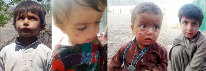 two children lose lives to measles in chagai two children lose lives to measles in chagai