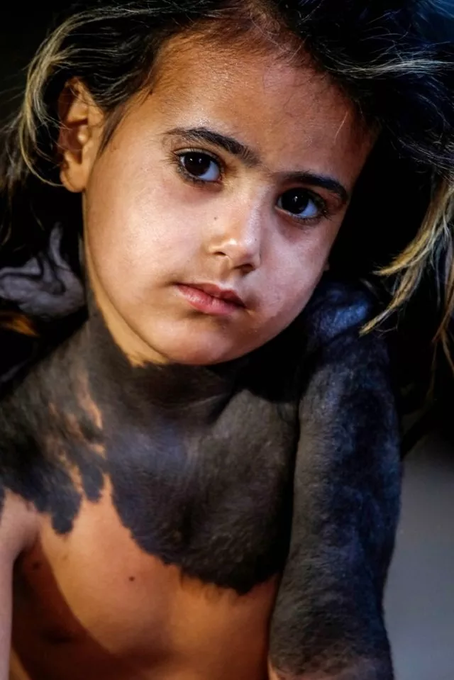 haura a four year old iraqi child with a rare skin congenital disease that covers much of her upper body in black marks and hair her condition an extreme form of naevus birthmarks or moles make her highly vulnerable to malignant melanoma the most dangerous form of skin cancer and her despairing family can 039 t afford to treat the condition april 17 2018 photo afp haura a four year old iraqi child with a rare skin congenital disease that covers much of her upper body in black marks and hair her condition an extreme form of naevus birthmarks or moles make her highly vulnerable to malignant melanoma the most dangerous form of skin cancer and her despairing family can 039 t afford to treat the condition april 17 2018 photo afp