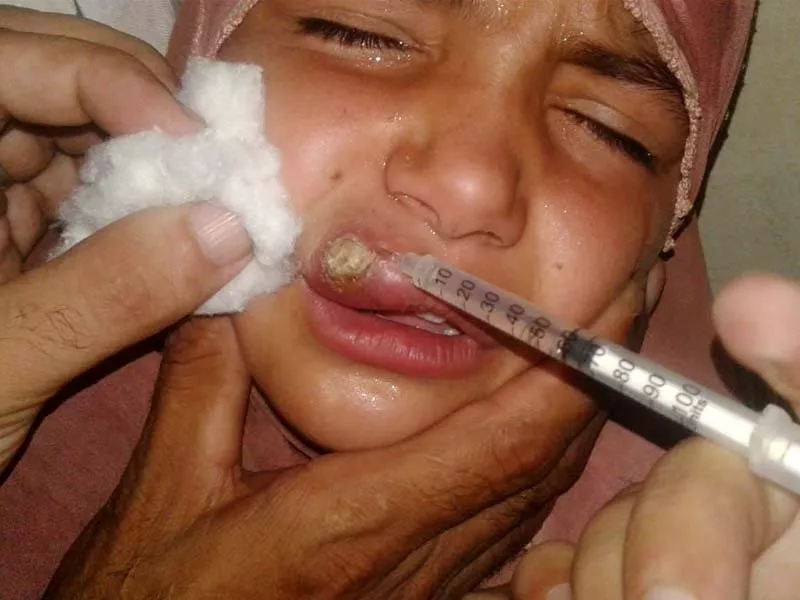 a doctor treats a leishmaniasis patient photo express a doctor treats a leishmaniasis patient photo express