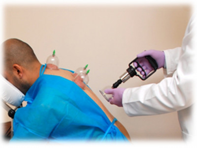 hijama therapy the cups of cure