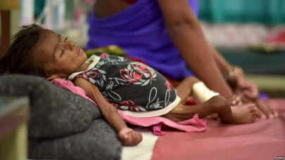 half of sindh s children suffer from stunted growth half of sindh s children suffer from stunted growth