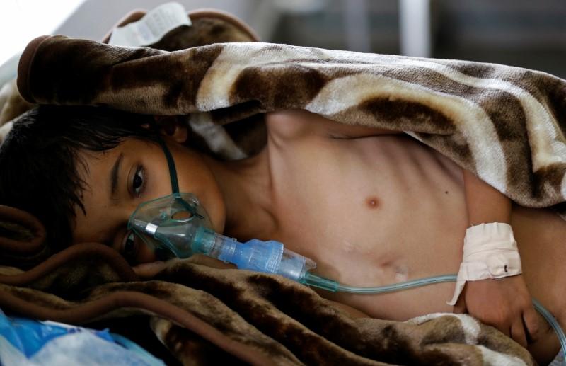 an eight year old malnourished boy lies on a bed in the emergency ward of a hospital in sanaa yemen photo reuters