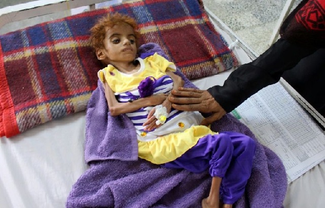 a yemeni child suffering from malnutrition is measured at a hospital in the hajjah province western yemen this month photo afp