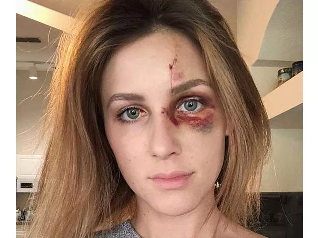 melissa gentz shares her photos of being beaten by millionaire drunk boyfriend photo courtesy mail online melissa gentz shares her photos of being beaten by millionaire drunk boyfriend photo courtesy mail online