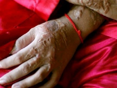 doctor critical after suffering burns from gas heater doctor critical after suffering burns from gas heater