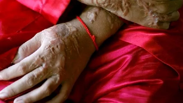 an acid attack victim photo reuters an acid attack victim photo reuters