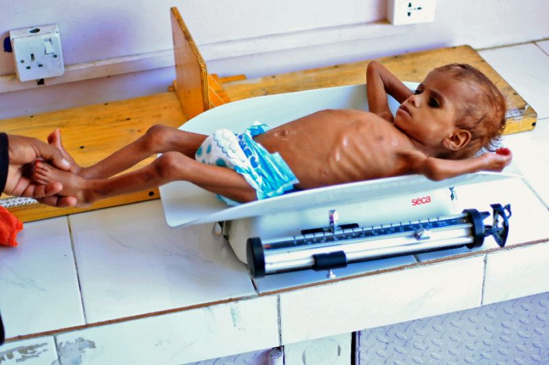 a yemeni child suffering from malnutrition is weighed at a treatment centre in the capital sanaa photo afp