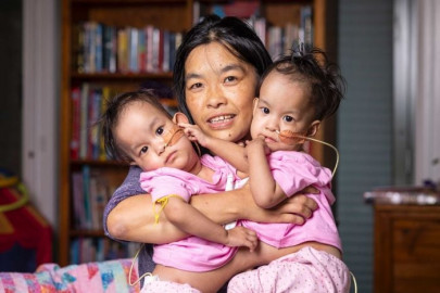 conjoined bhutanese twins undergo separation surgery conjoined bhutanese twins undergo separation surgery