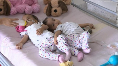 previously conjoined twin girls long for each other post surgery previously conjoined twin girls long for each other post surgery