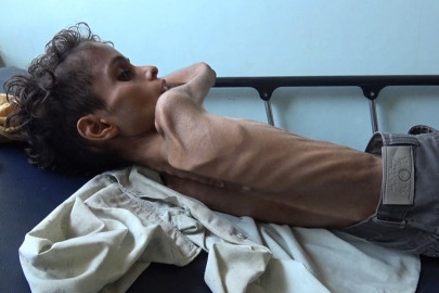 starvation leaves yemeni boy ghazi too weak to cry starvation leaves yemeni boy ghazi too weak to cry