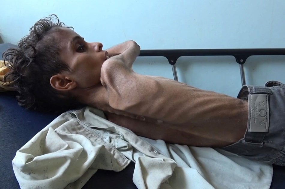 10 year old ghazi saleh lies on a hospital bed in the southwestern yemeni city of taez barely breathing he only weighs eight kilograms photo courtesy abs cbn news