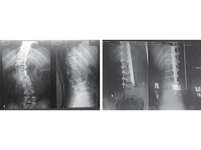 x ray images of a patient before and after fixing of screws and rods in her spine at ath photos express