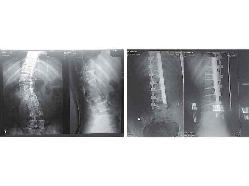 x ray images of a patient before and after fixing of screws and rods in her spine at ath photos express