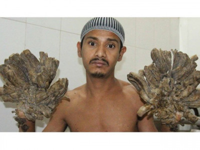 bangladeshi tree man dreams of cure as rare skin disease returns bangladeshi tree man dreams of cure as rare skin disease returns