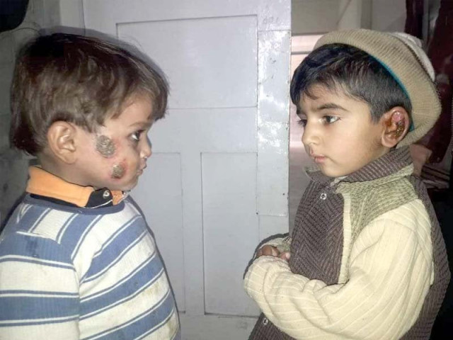 two young patients look at each other in leishmania centre in peshawar photo express two young patients look at each other in leishmania centre in peshawar photo express