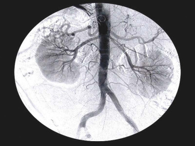 incidence of kidney failure shows sharp increase